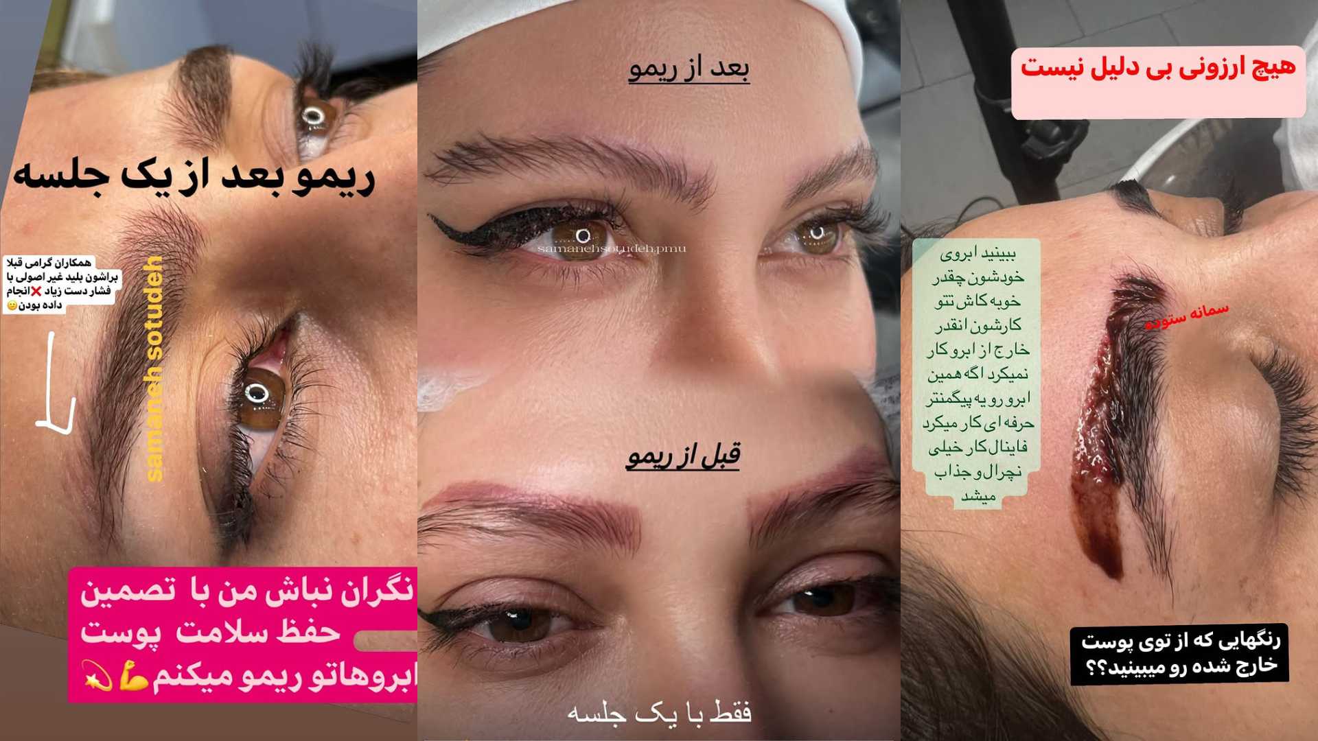 ریمو تتو و ریمو میکروبلیدینگ ابرو در رودهن | تخصصی در سالن سمانه ستوده